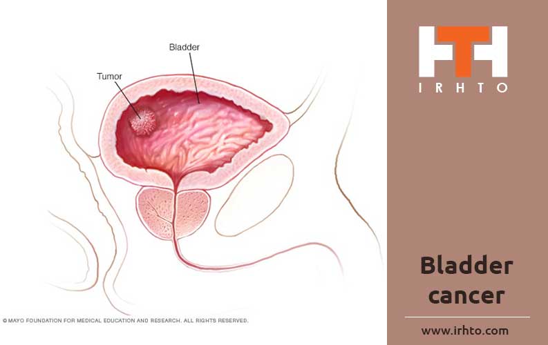 Bladder Cancer