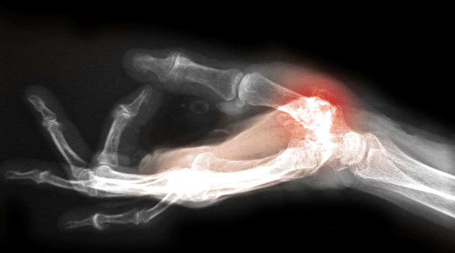 Arthritis