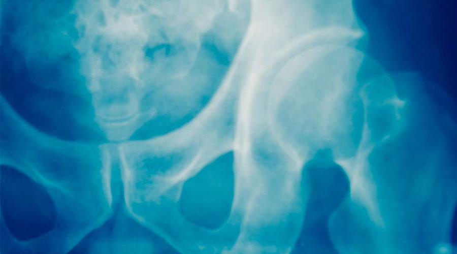 Bone Cancers