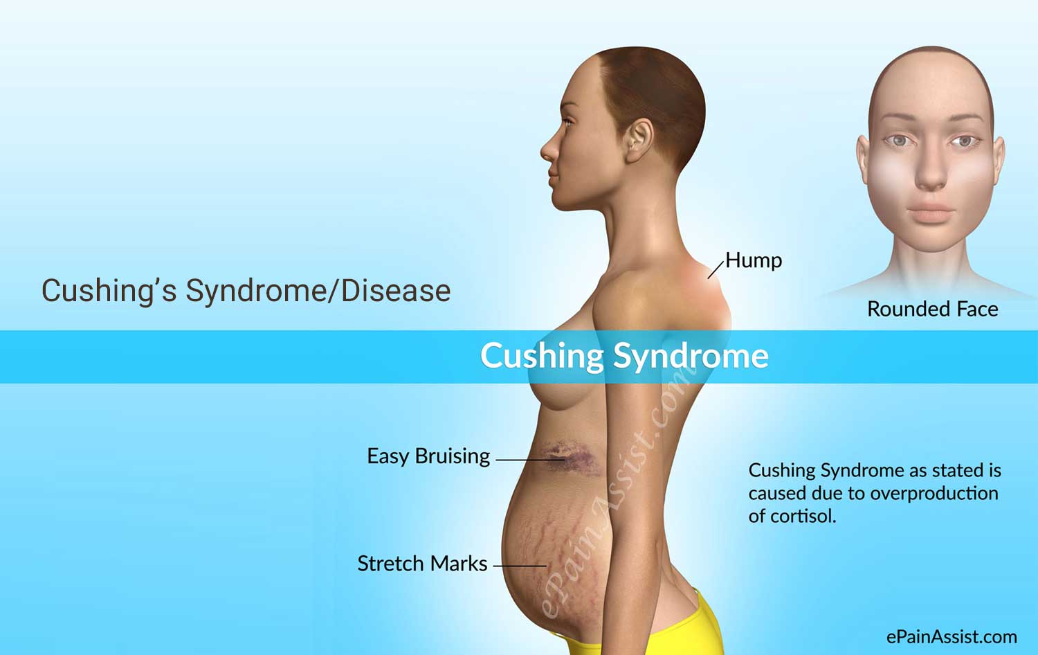Cushing’s Syndrome/Disease