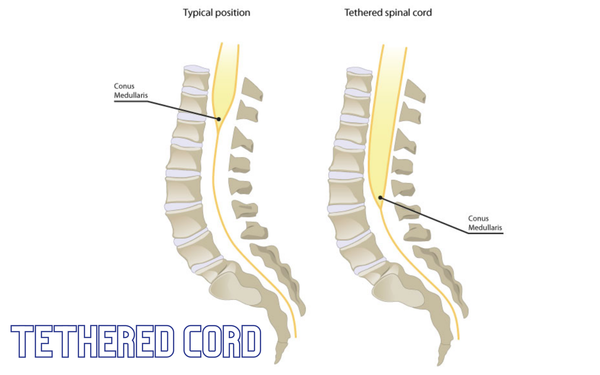 Tethered Spinal Cord Syndrome