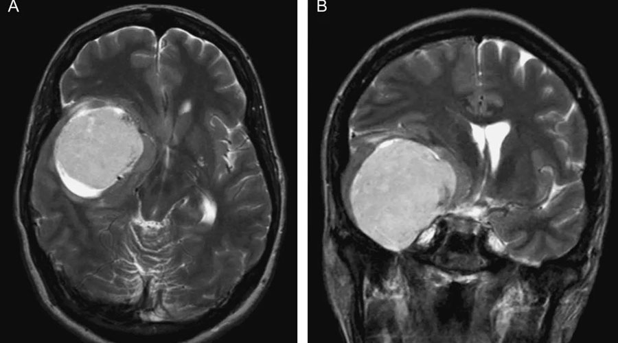 Meningiomas