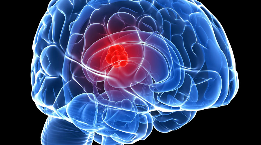 Metastatic Brain Tumors