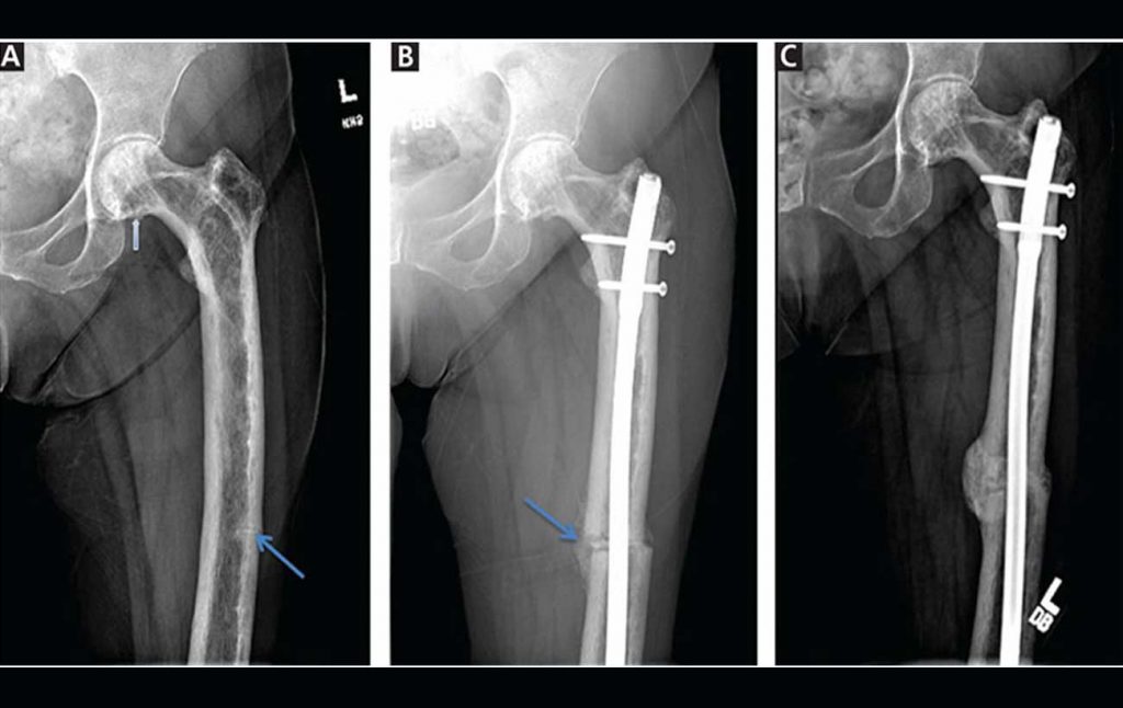 Paget Disease of the Bone - IRAN Health Tourism Organizer - Iran ...