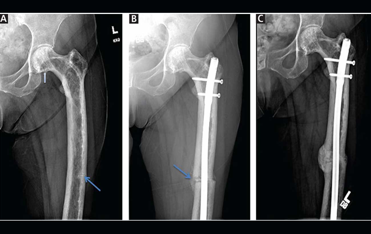 Paget Disease Of The Bone