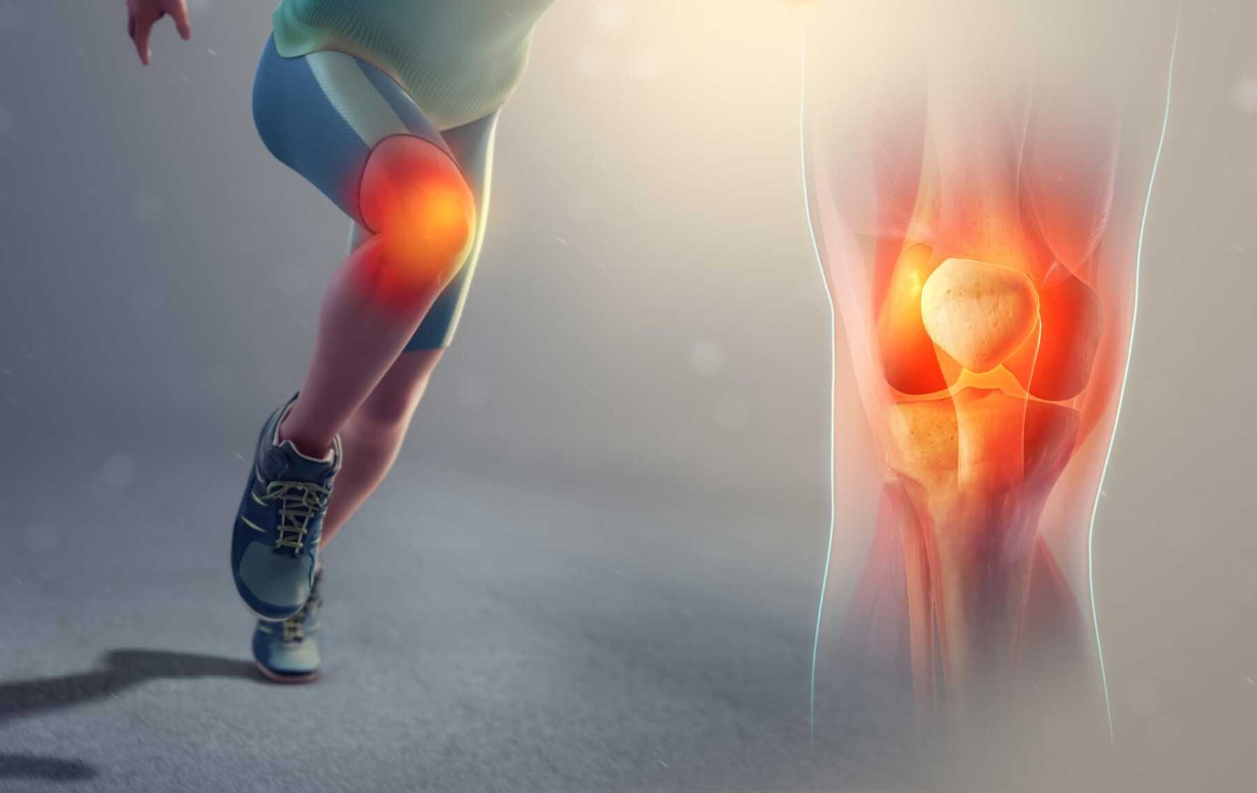 Patellofemoral Stress Syndrome (Runner’s Knee)