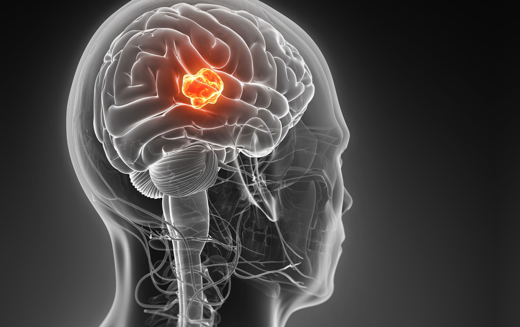 Pediatric Brain Tumors