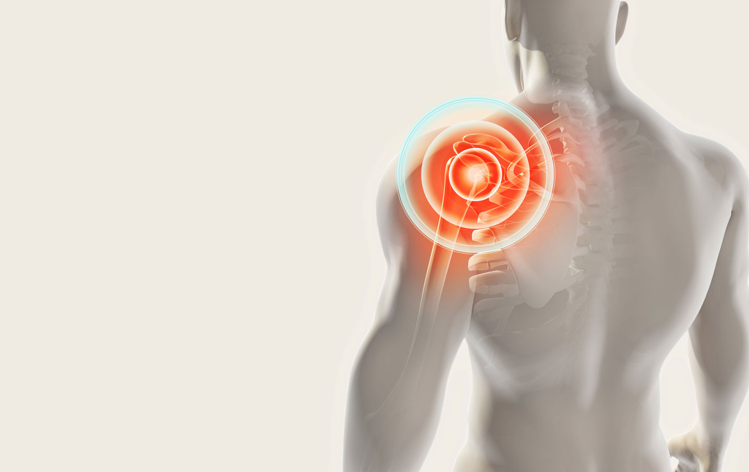 Rotator Cuff Injury