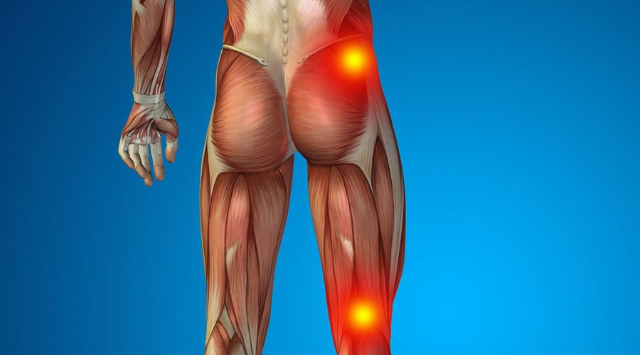 Sciatica