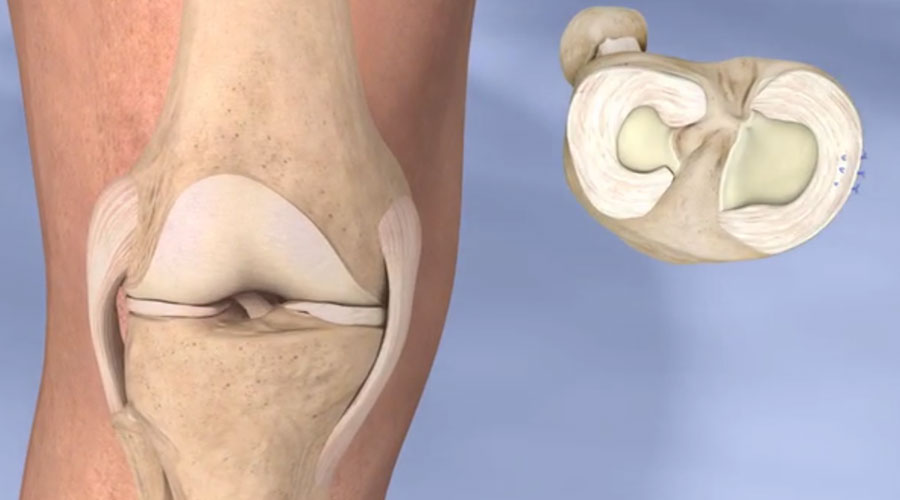 Torn Meniscus
