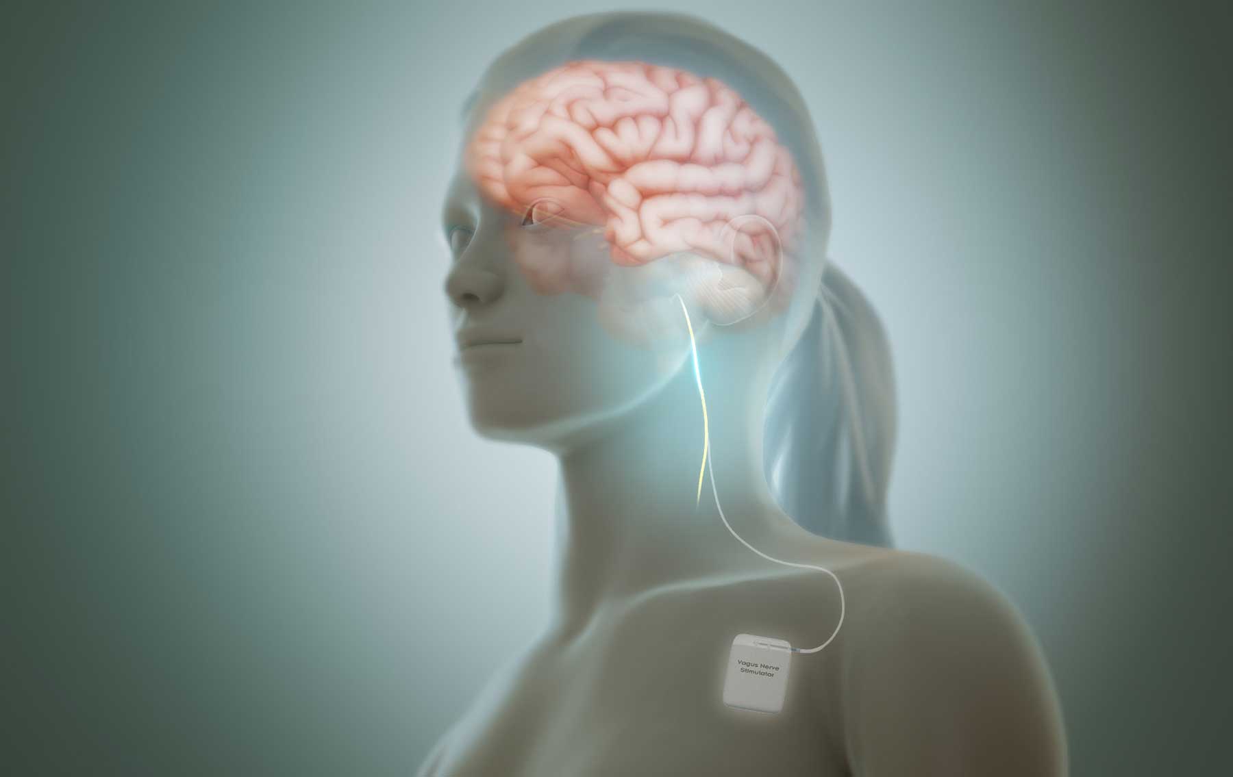 Vagus Nerve Stimulation