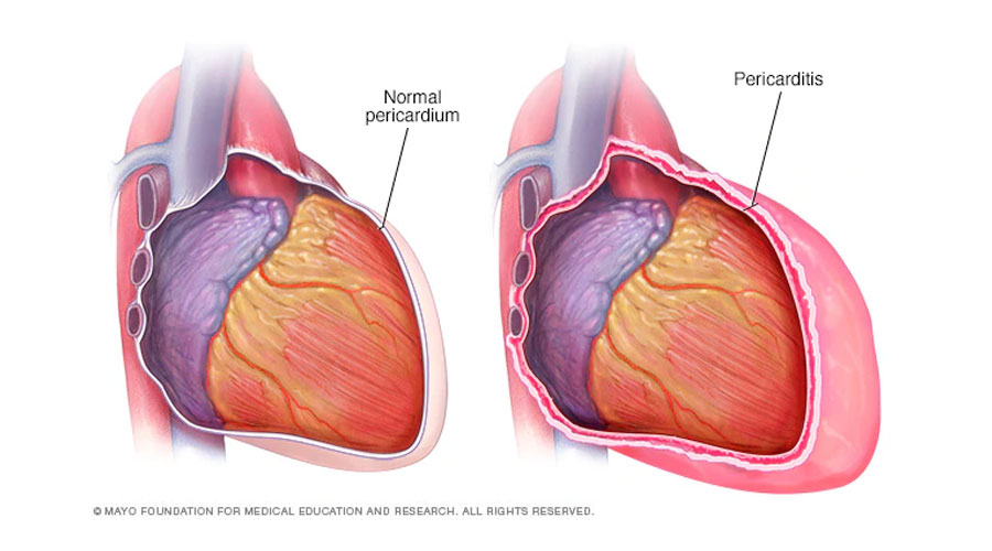 Acute Pericarditis