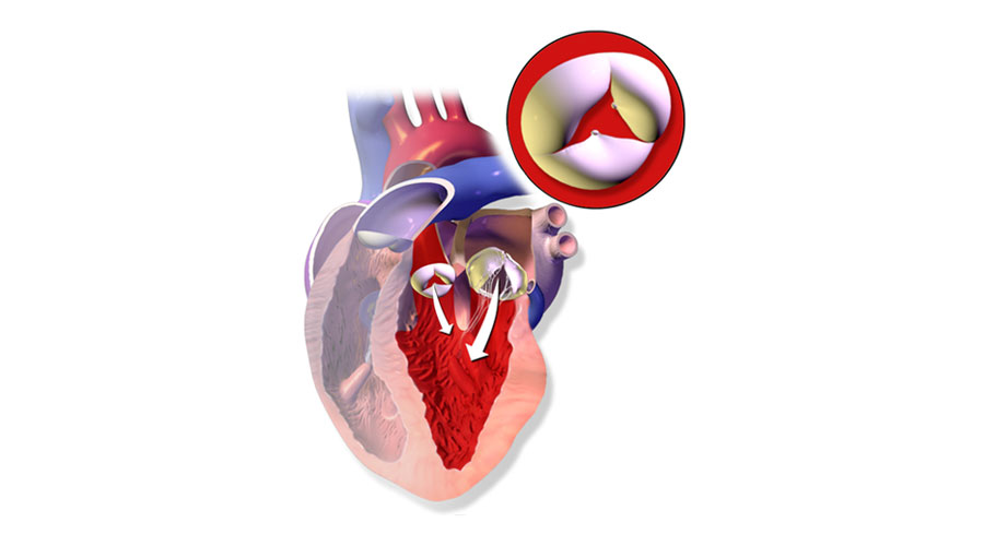 Aortic Insufficiency