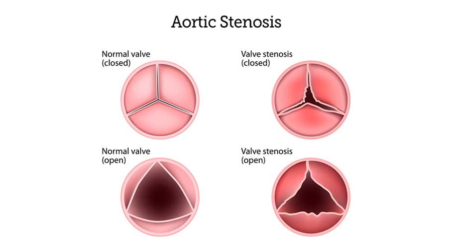 Aortic Stenosis