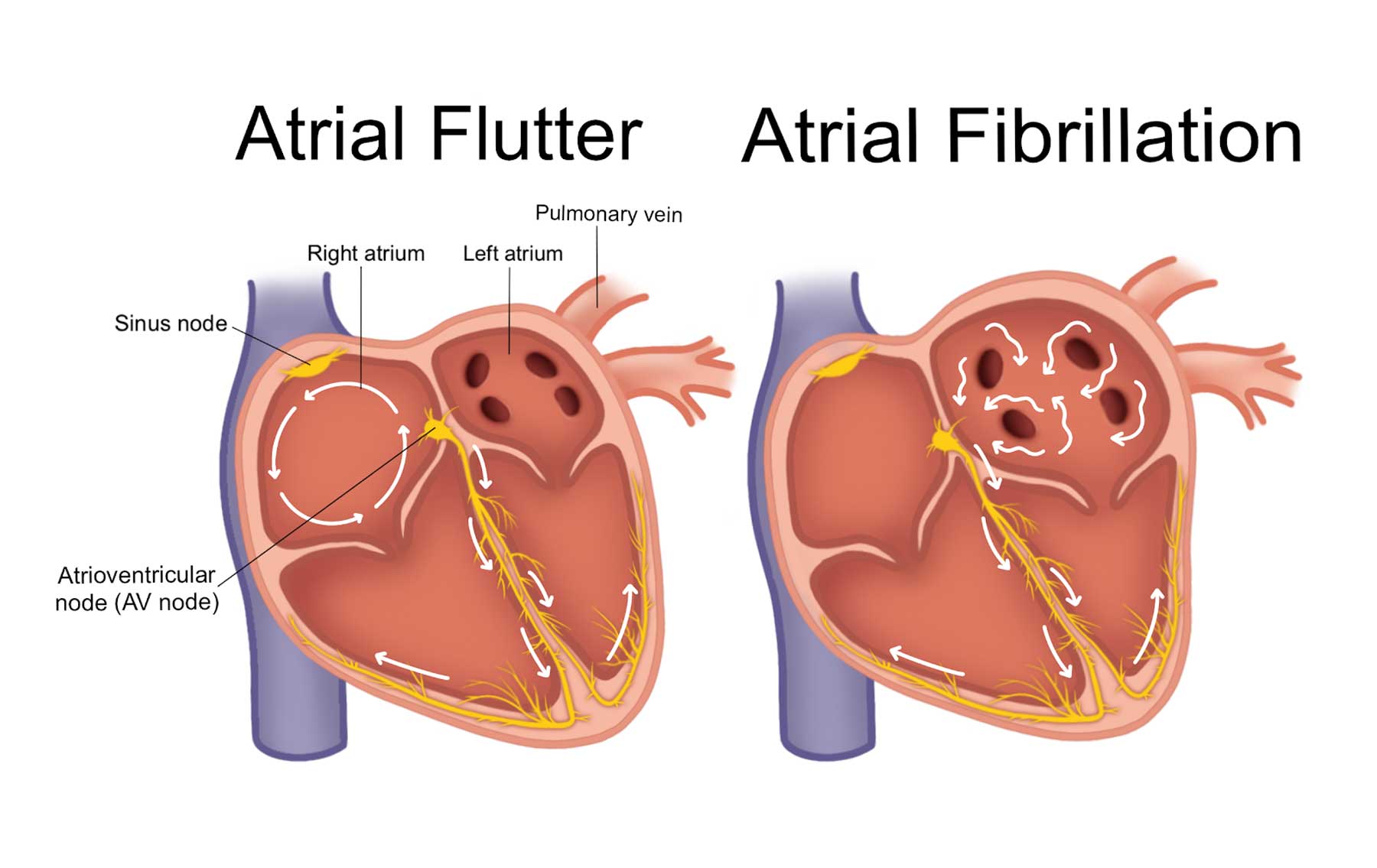 effect of altitude on atrial flutter vs fibrillation