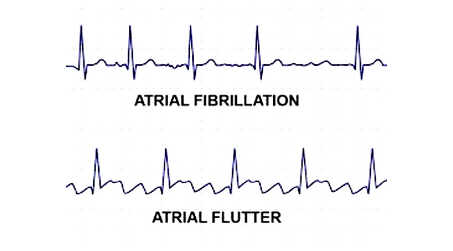 atrial fibrillation vs atrial flutter