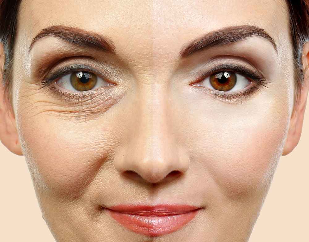 Blepharoplasty