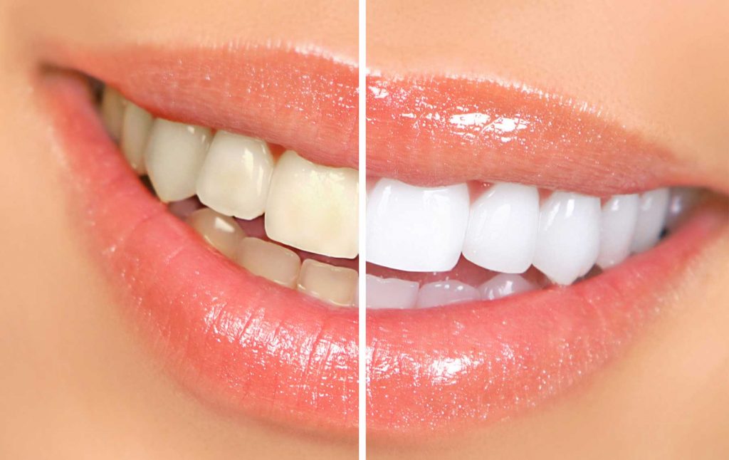 Complex Dental Restorations