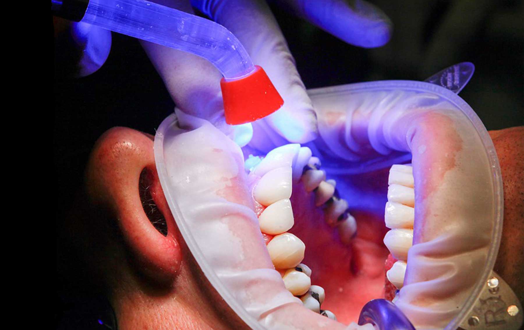 Complex Dental Restorations