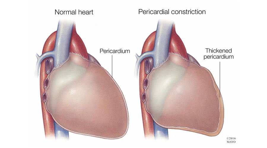 pericarditis