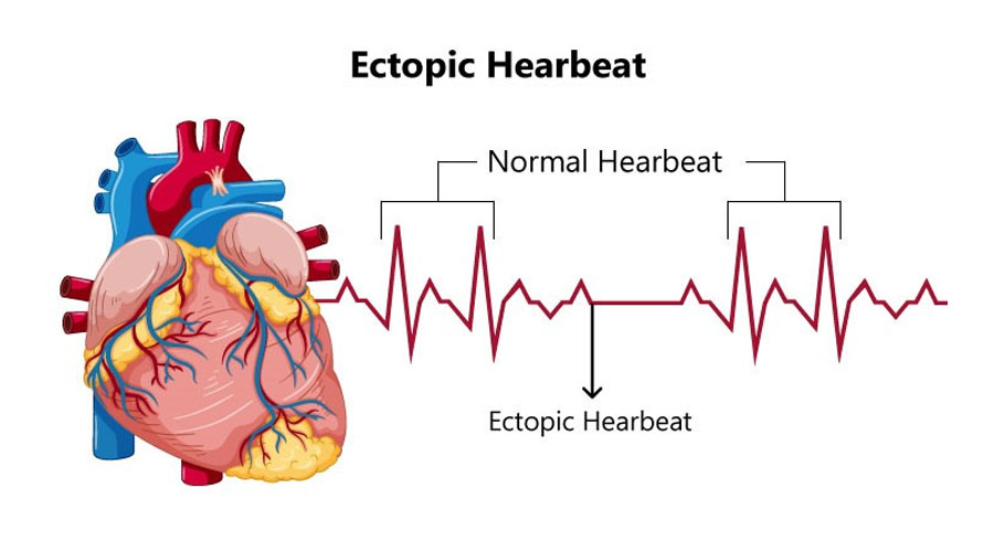 ectopic heartbeat
