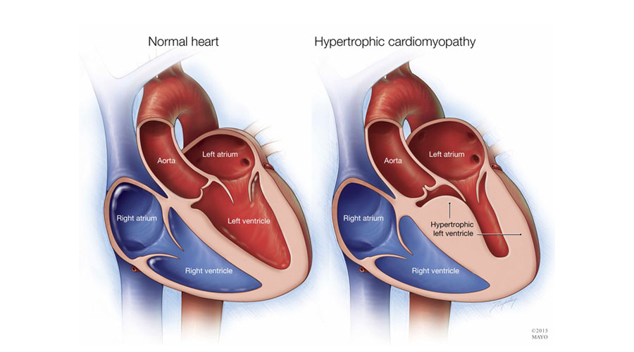 Hypertrophic Cardiomyopathy - Iran Health Tourism Organizer - Iran 