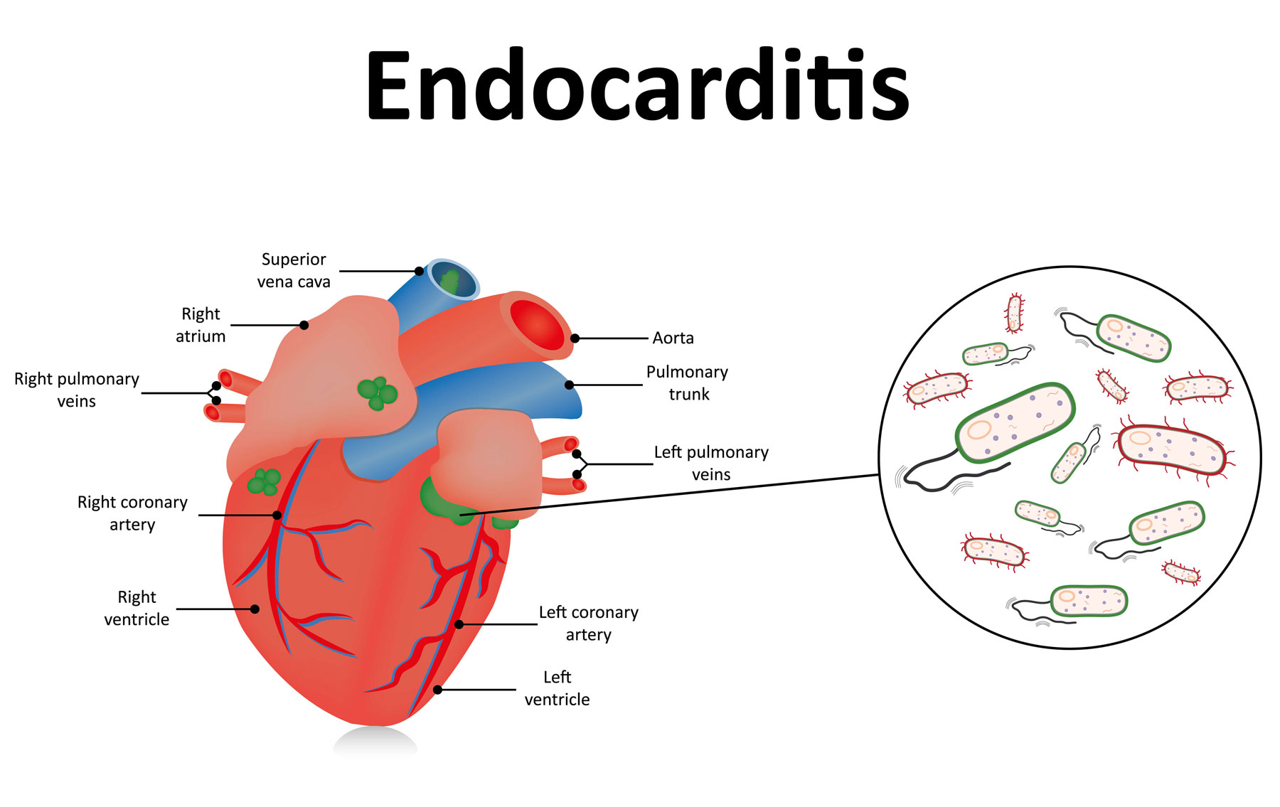 Infective Endocarditis