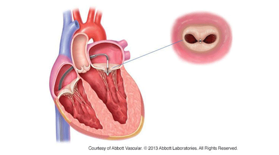 Mitral Regurgitation