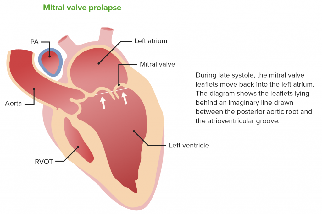 Mitral Valve Prolapse