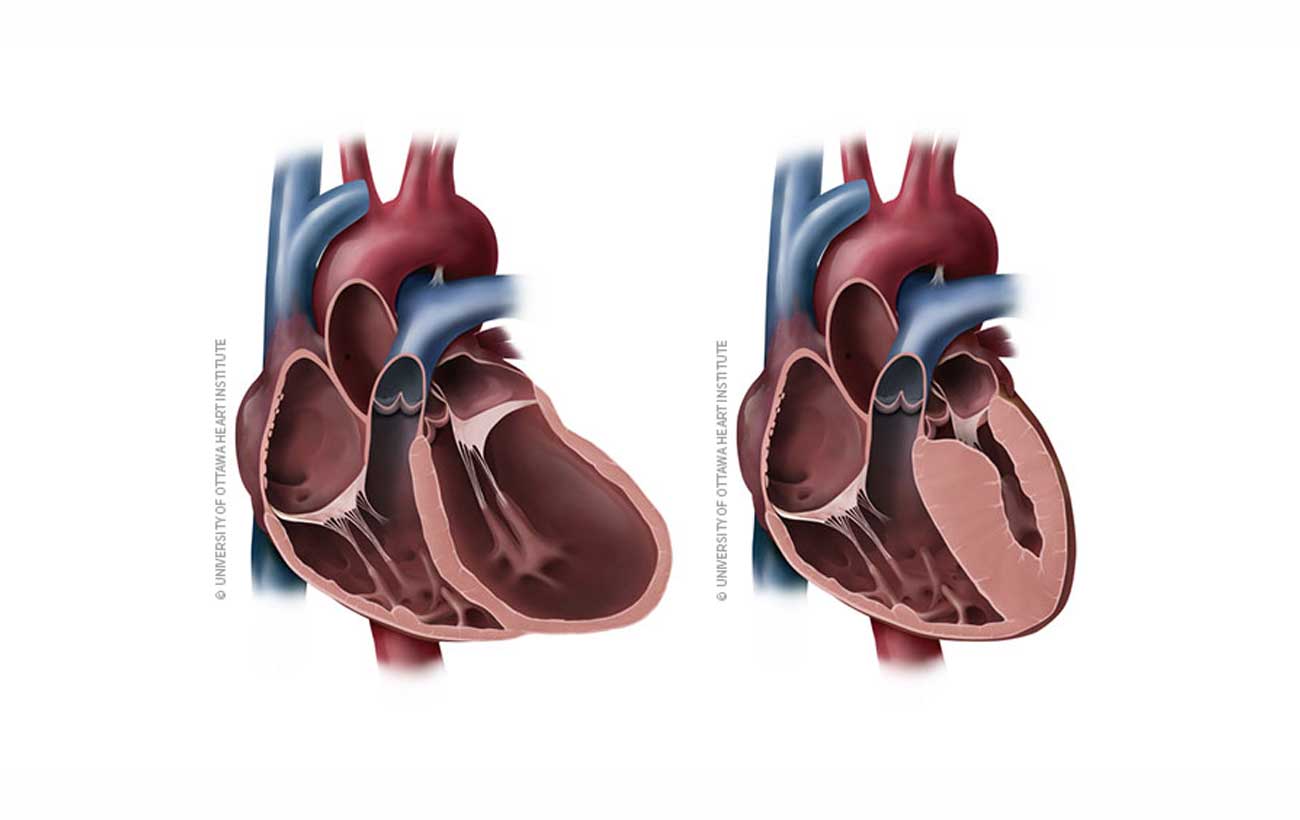 Nutritional Cardiomyopathy