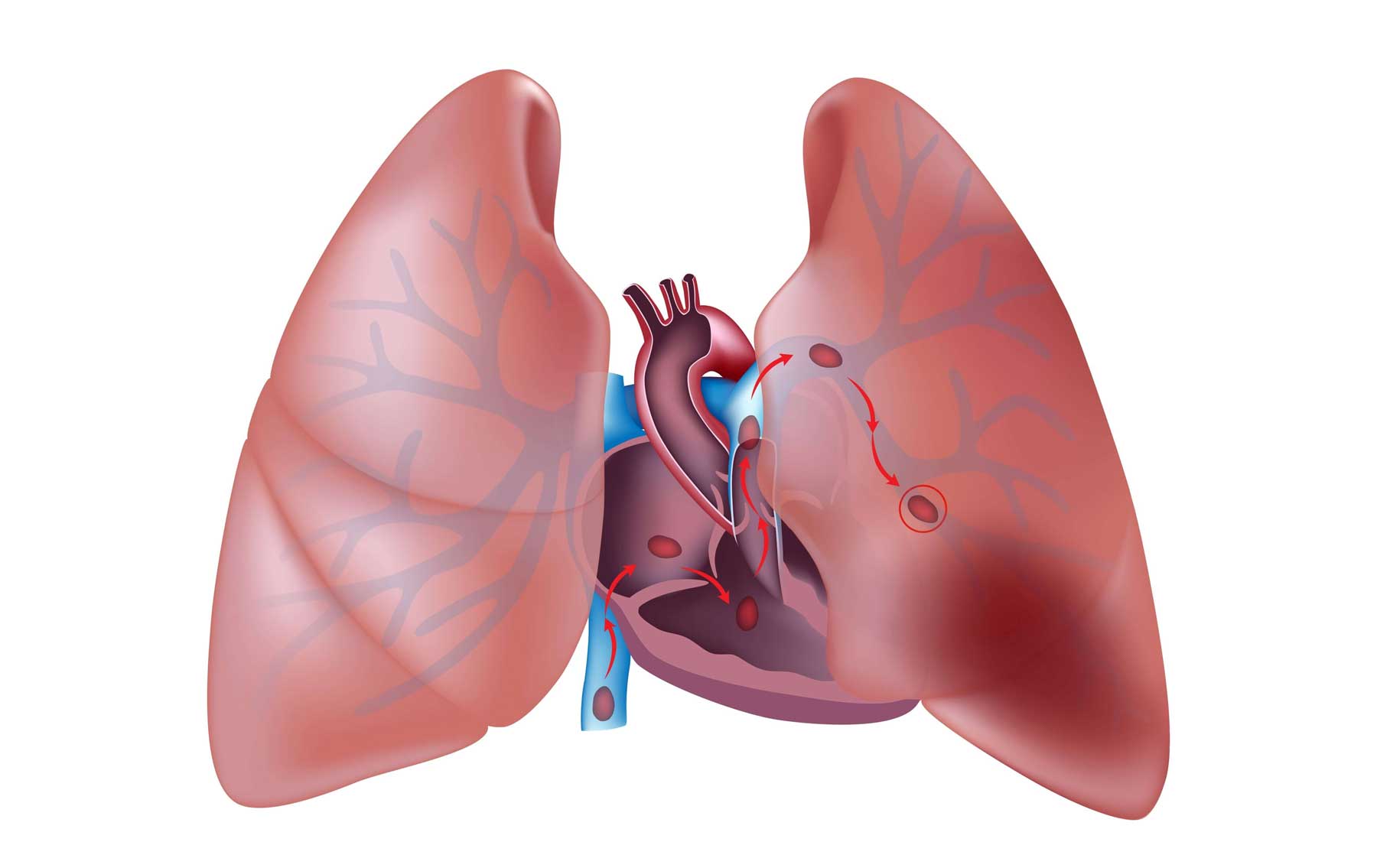 Pulmonary Embolism