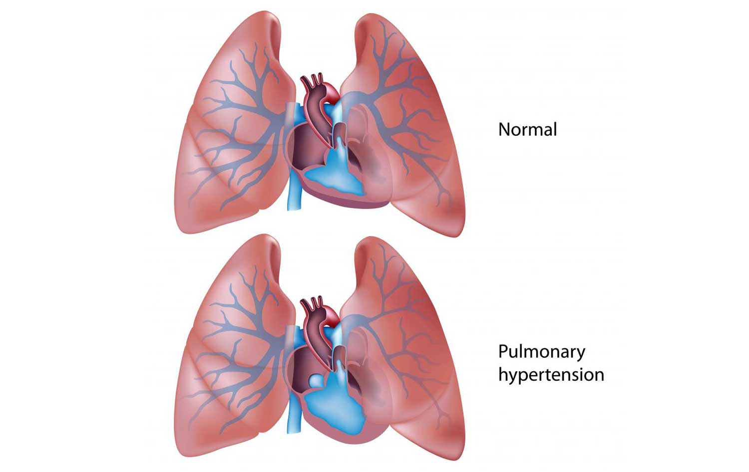 Pulmonary Hypertension