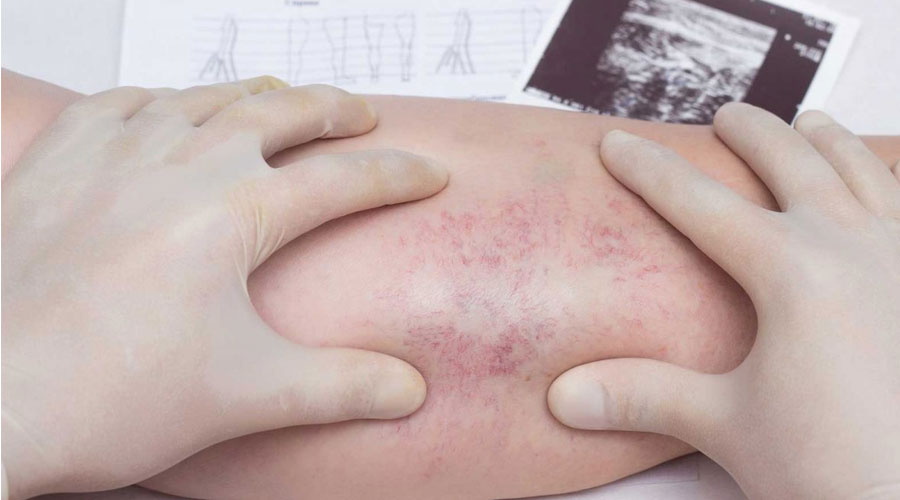 Thrombophlebitis