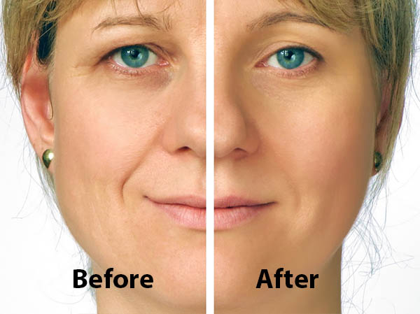 Blepharoplasty