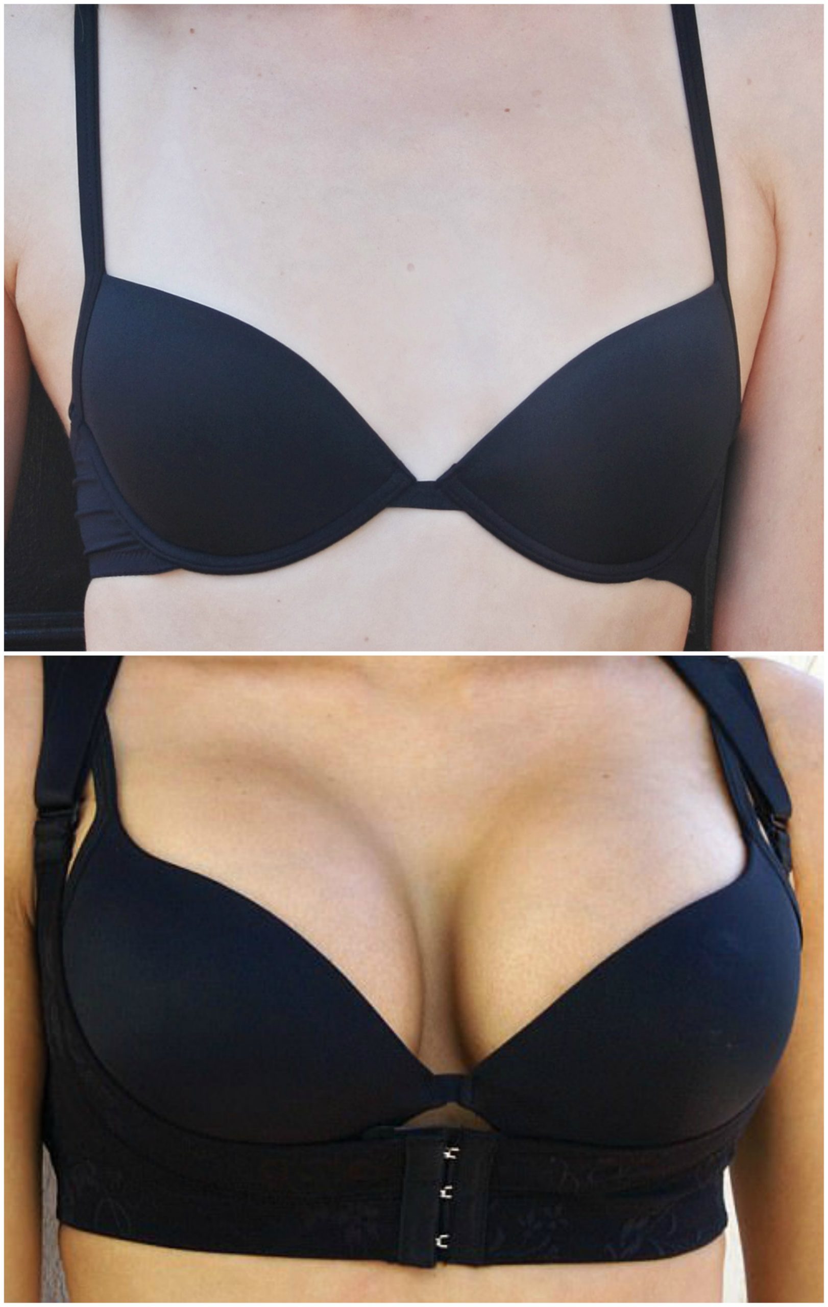 Breast Enlargement