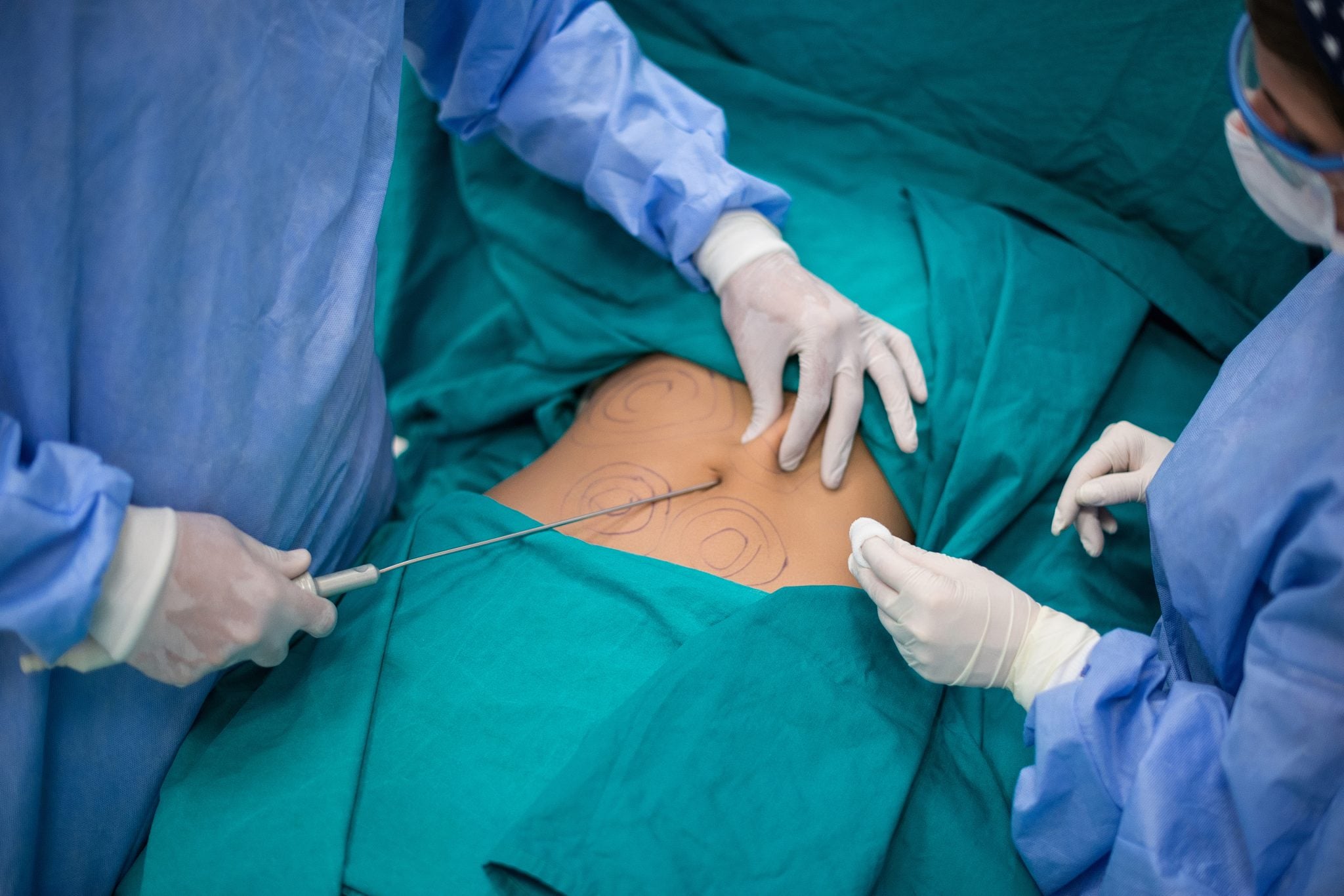 Liposuction Risks