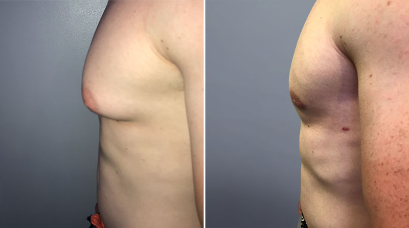 Male Breast Reduction