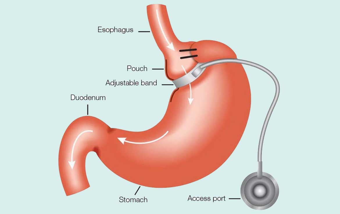 Adjustable gastric band