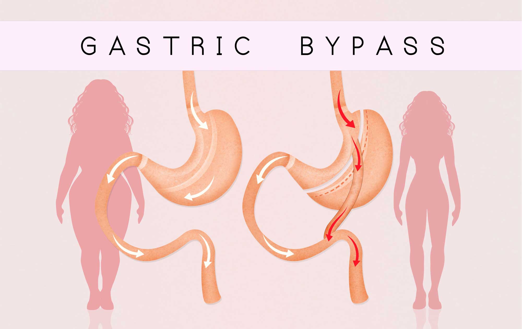 open gastric bypass