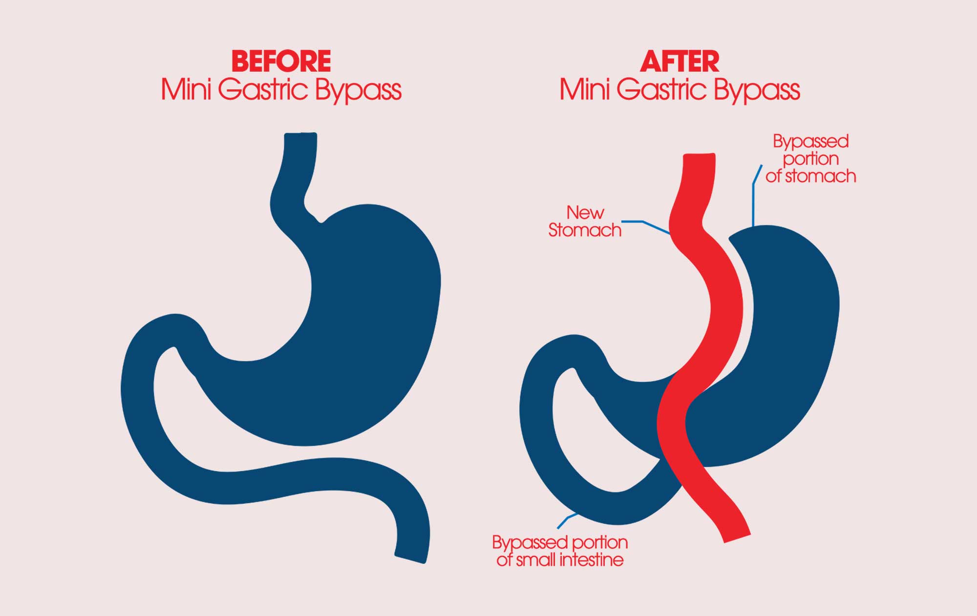 Mini-Gastric Bypass