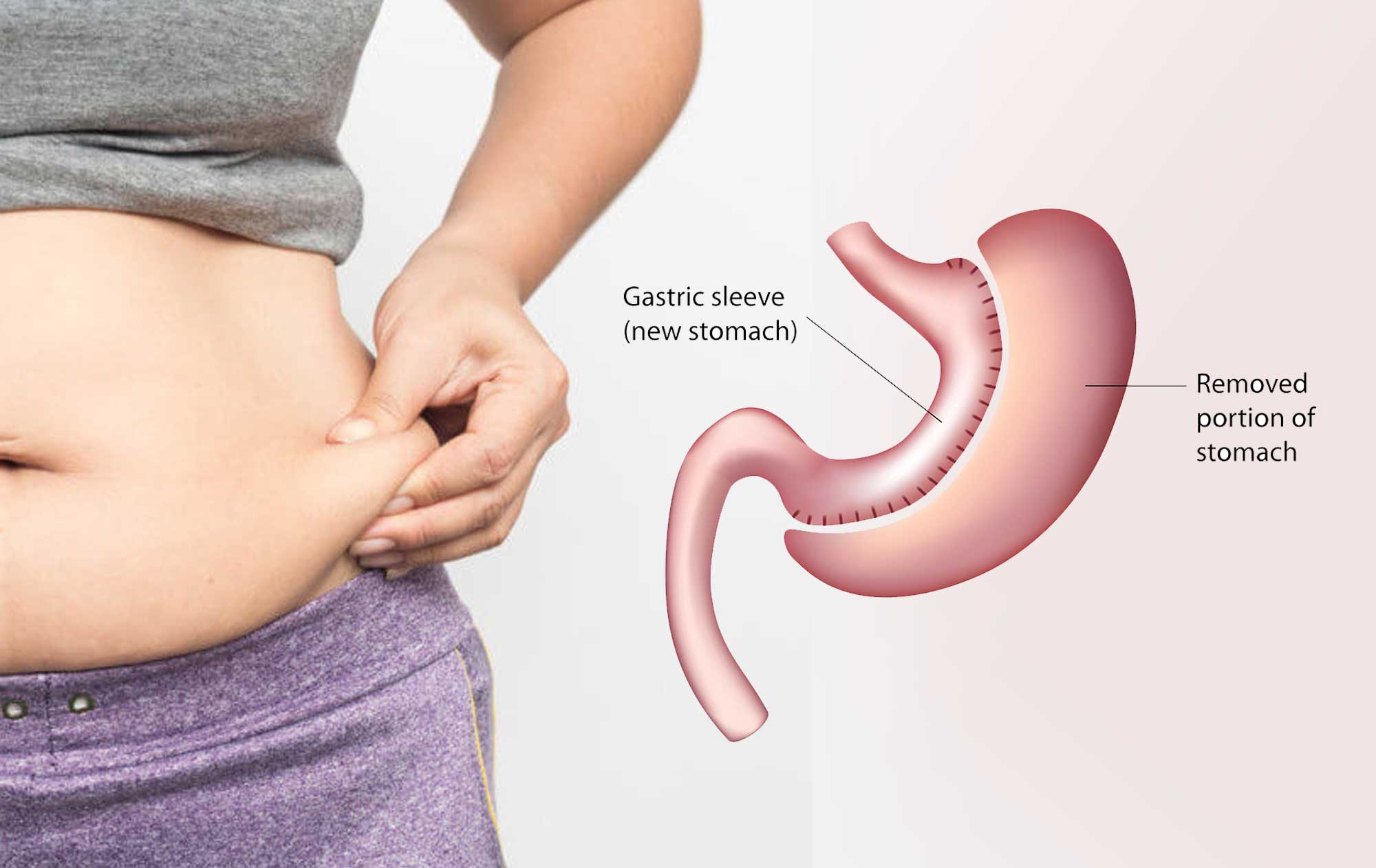 Sleeve Gastrectomy