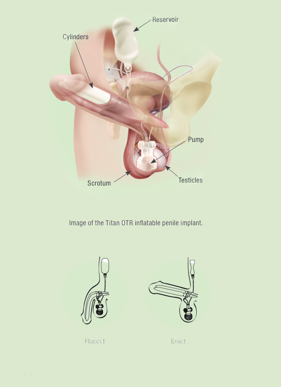 Penile Implant IRAN Health Tourism Organizer Iran Medical