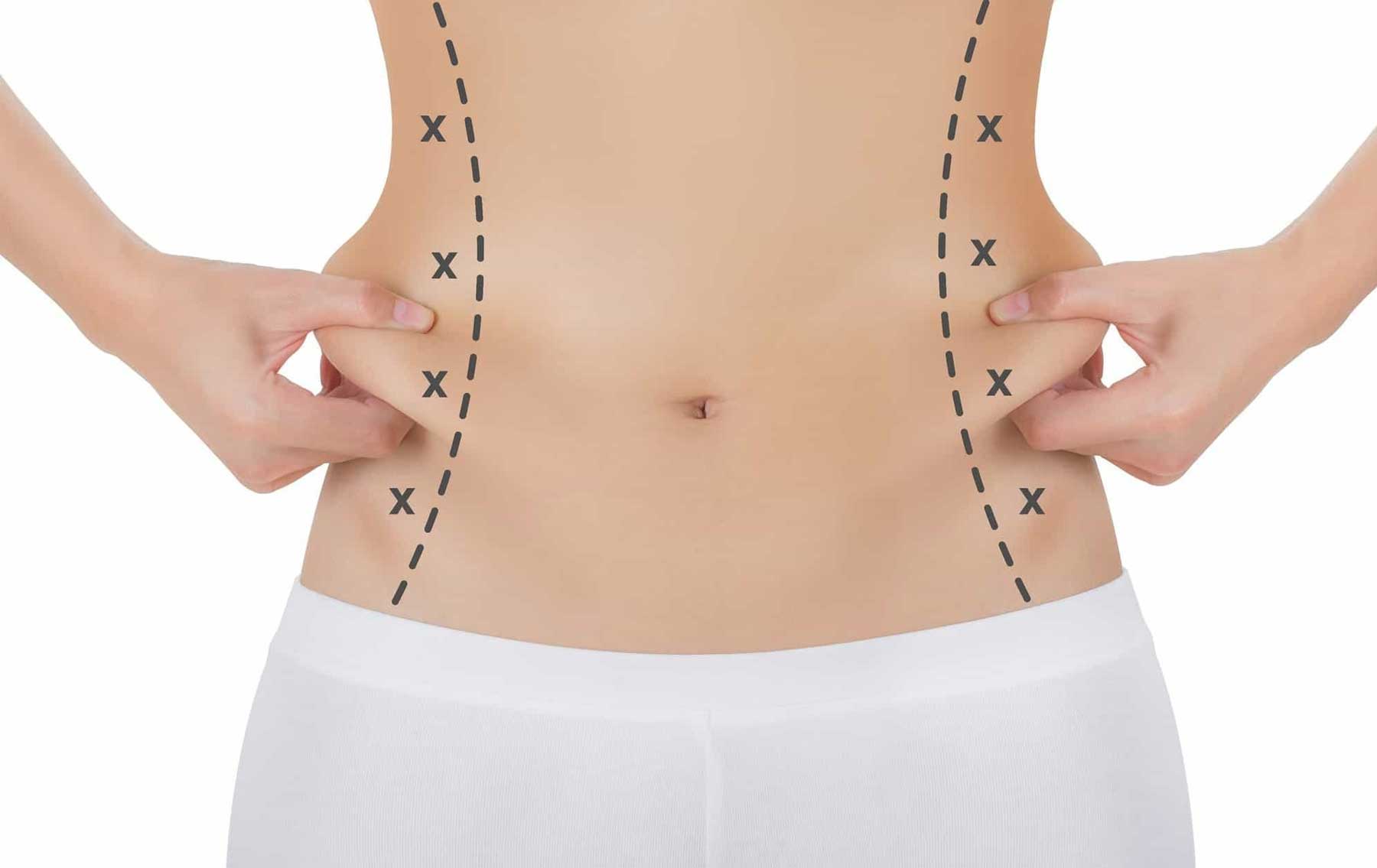 Liposuction